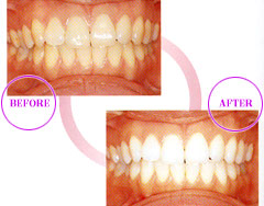 ホワイトニング